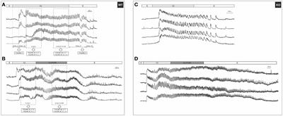 The effect of forskolin and the role of Epac2A during activation, activity, and deactivation of beta cell networks